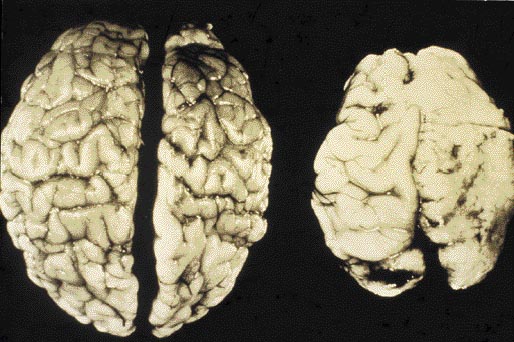 Newborn Brain